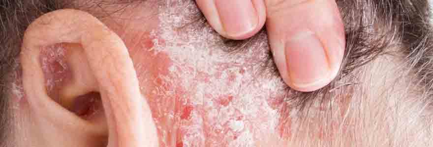 soulager le psoriasis du cuir chevelu